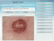 Tablet Screenshot of basalcellpictures.com